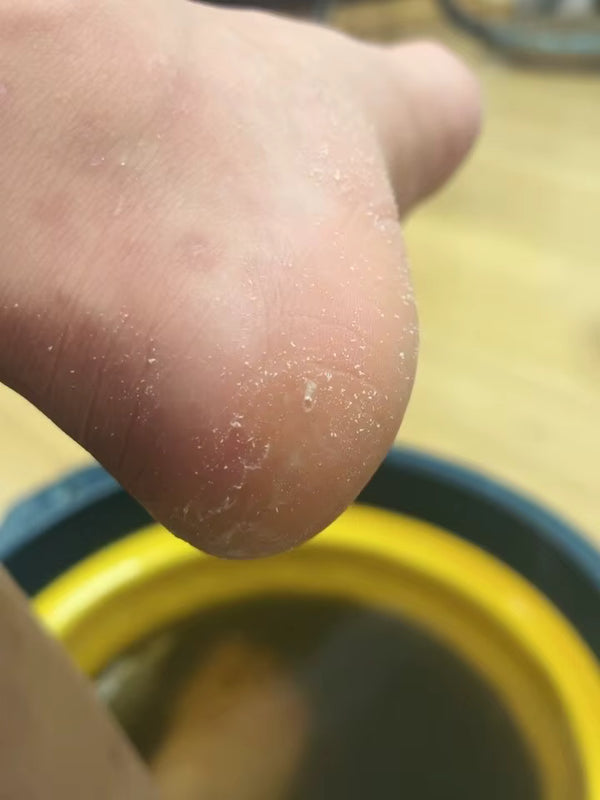 Better than pumice stones