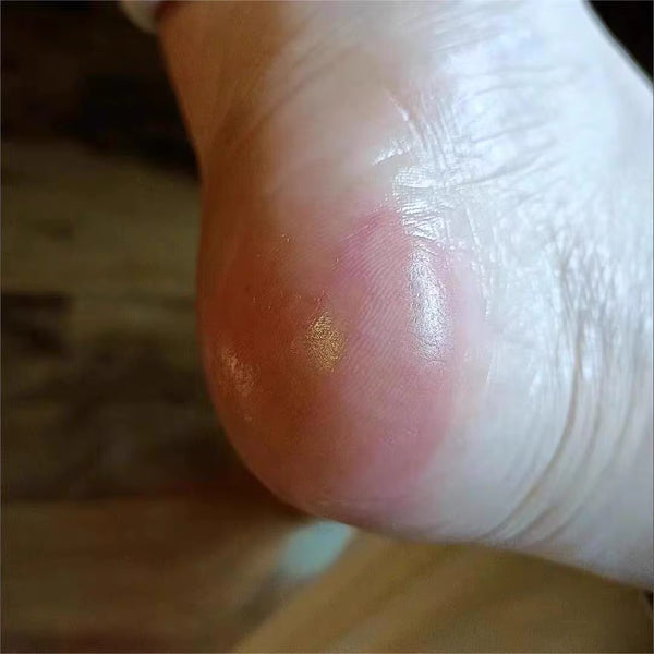 Perfect for cracked heels